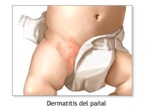dermatitis