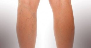 VARICES: EMOCIONES QUE NO FLUYEN