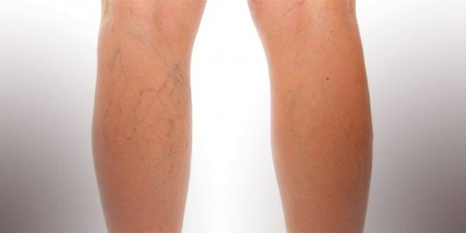 VARICES: EMOCIONES QUE NO FLUYEN