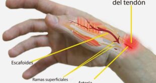 conflicto emocional tendinitis
