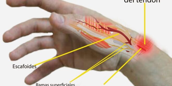 conflicto emocional tendinitis